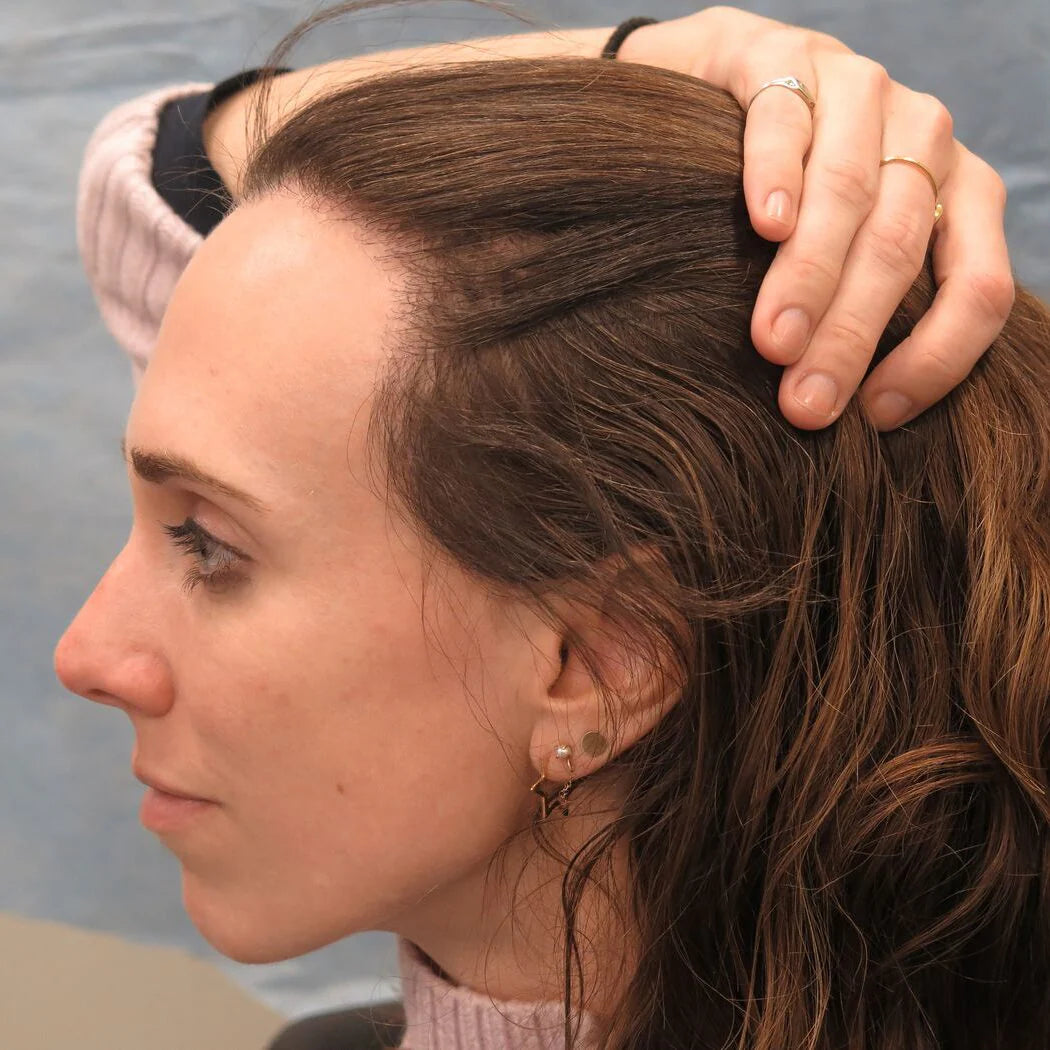 files/high-female-hairline-1050x1050.webp